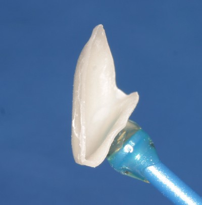 Esthetic dentistry laninate veneers
